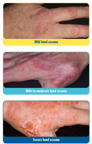Hand_Eczema_Examples